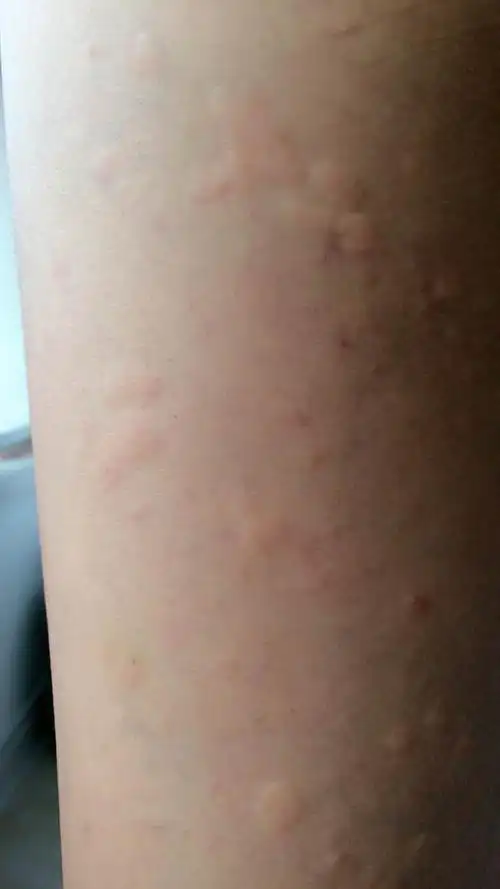 早上起床宝贝腿上起了好多大包,不知是过敏还是荨麻疹,奇痒无比,用