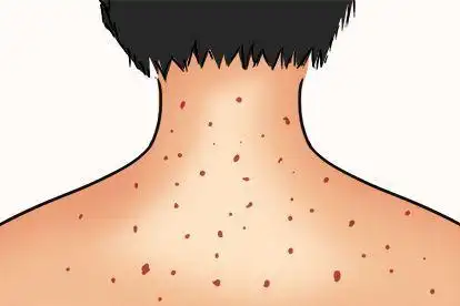 梅毒与湿疹区别图片_39健康网_精编内容