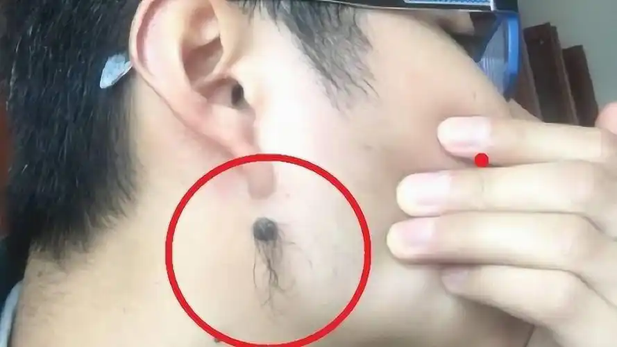 痣上长毛是好是坏面相大师给出解答别再乱点了