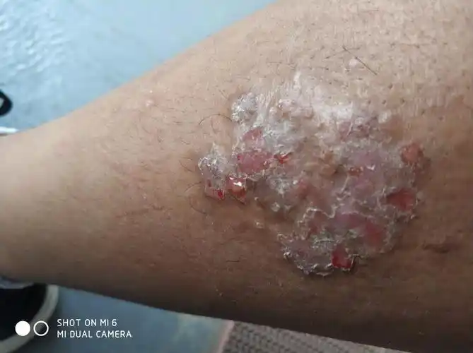 请问这是什么癣?身上就腿上这一块,好多年了