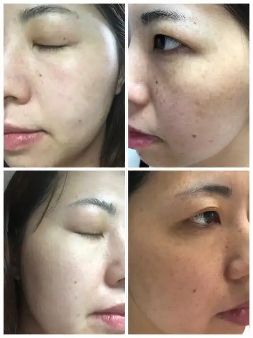 第一次激光祛斑经验分享