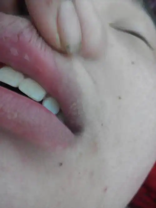 我这是怎么回事啊嘴角有好多小白点