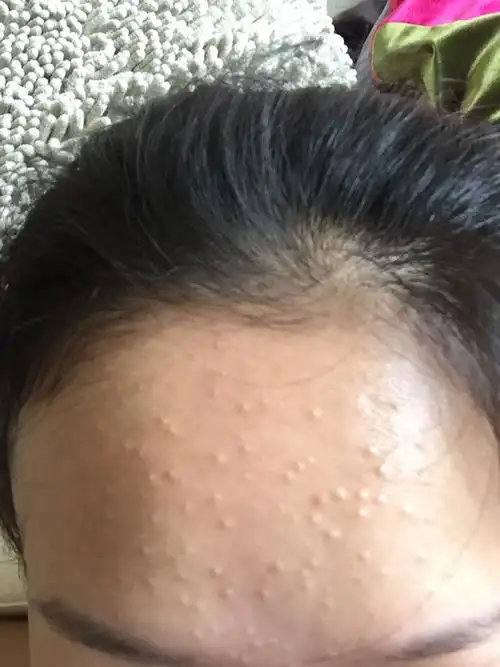 脸上长了很多闭合性的粉刺,是什么原因啊?两个月了
