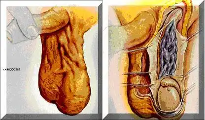 精索静脉曲张疼痛吃什么药