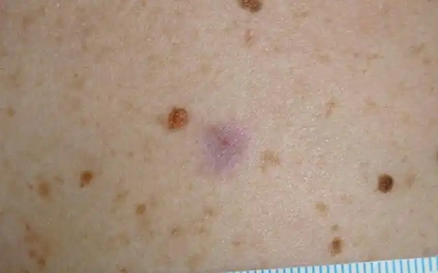 小小红斑 皮肤镜检查有大用