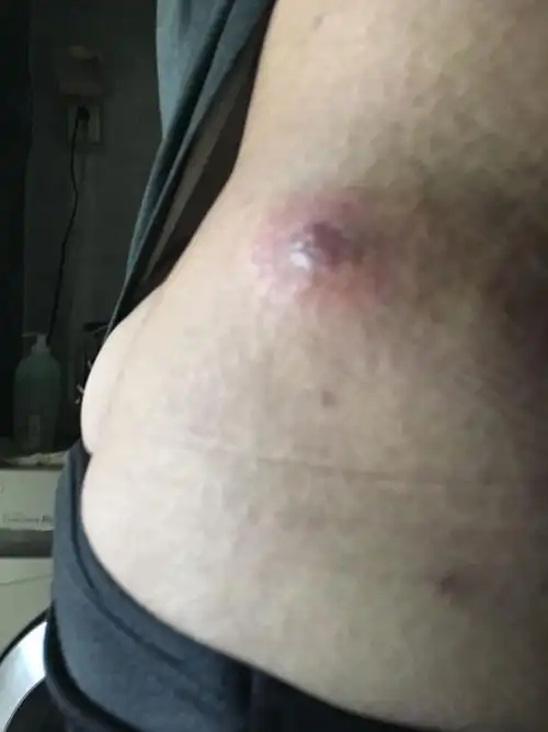 我的腰上长个东西,一碰就疼,里面有浓,挤出来一些,里面有白色的东西!