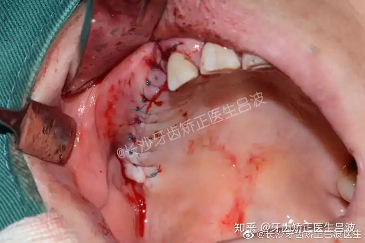 什么是上颌窦囊肿?