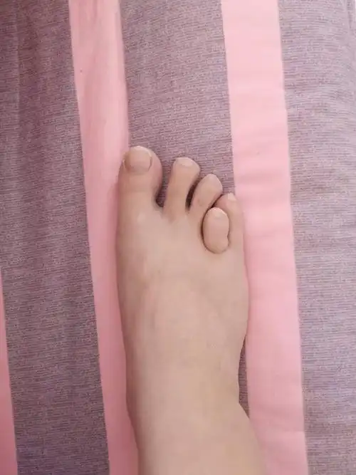 脚趾短小症 - 好大夫在线