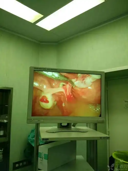 腹腔镜手术中看到一侧卵巢排卵