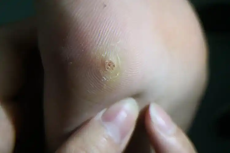 跖疣脚上皮肤内黑点图