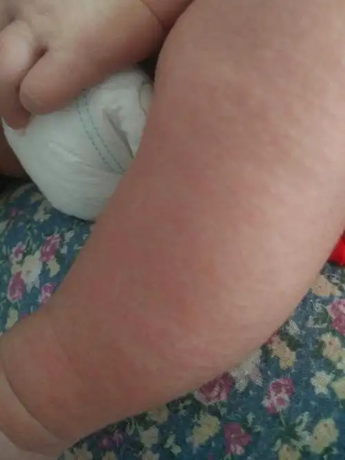 宝宝起湿疹了