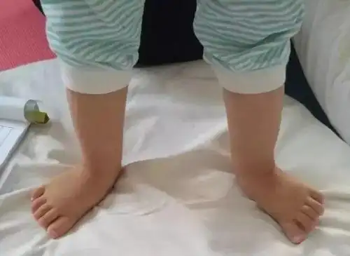 儿康进行时第52期孩子有足外翻应该怎么办