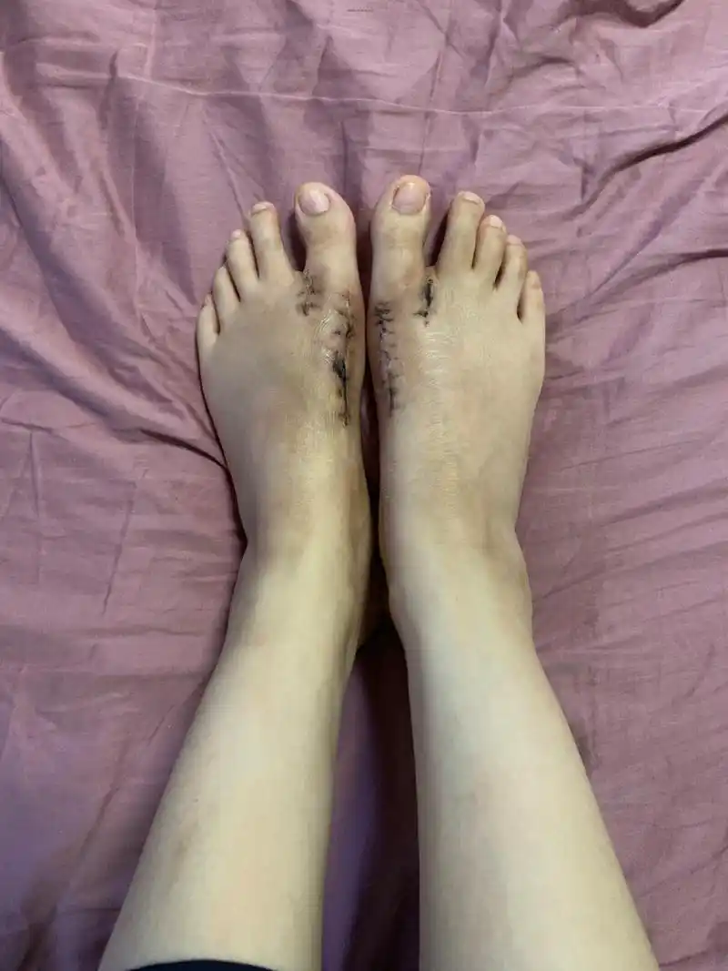 拇外翻手术第24天(术前后对比图) 把夹在大拇指的拿掉,4个脚趾很快就