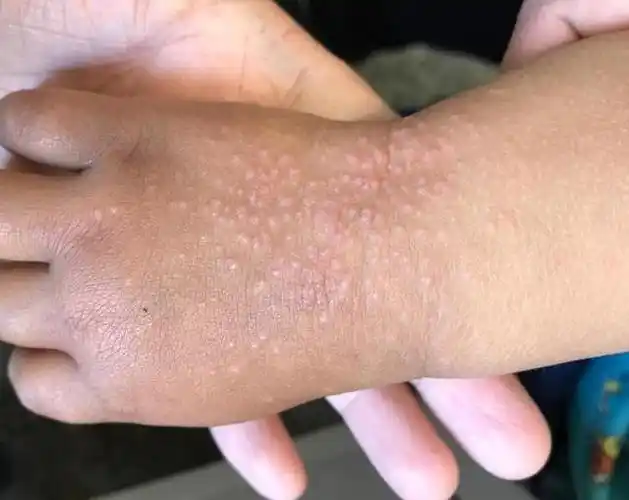 我又说,这个病也被称之为「沙土皮炎」,意思是多和孩子玩弄泥沙,玩