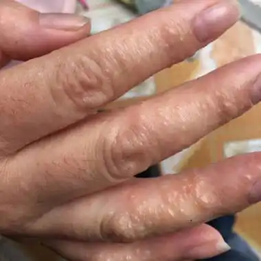 怀孕快12周了,手上长了很多小水泡,痒得不行,去医院看了说是湿疹,开了