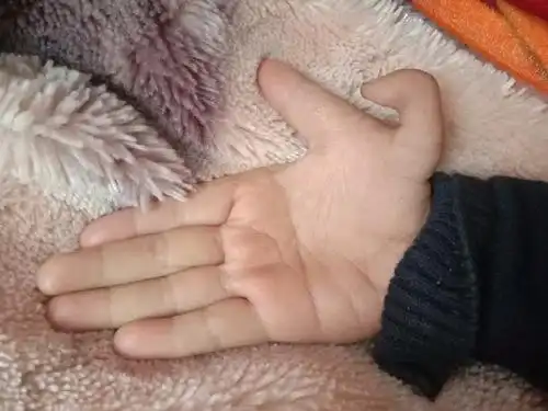 孩子六指需要动手术吗