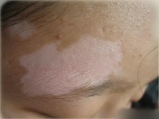 蛔虫脸上白斑图片50