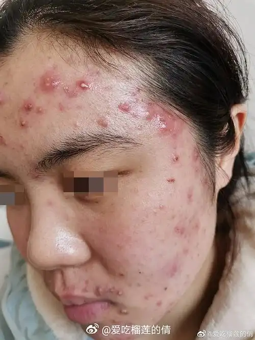 额头和口周长红肿的大痘痘,外用红霉素后爆痘.