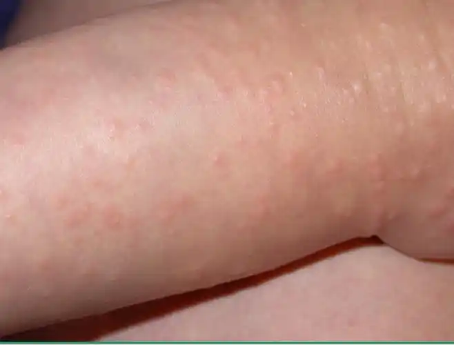 夏天到来,小朋友的皮肤出现小丘疹,这是什么病?