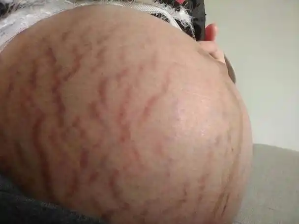 什么样的孕妇容易留下妊娠纹?