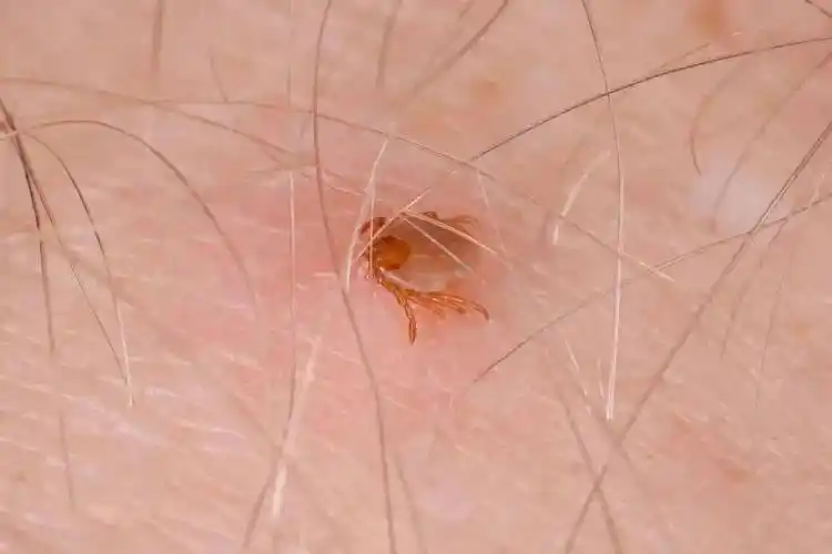 后)1个月内出现如下症状应该及时就诊,并告知医生你的活动史或叮咬史