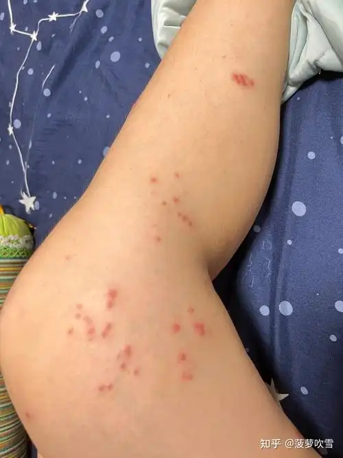 记录腿部神经性带状疱疹病史