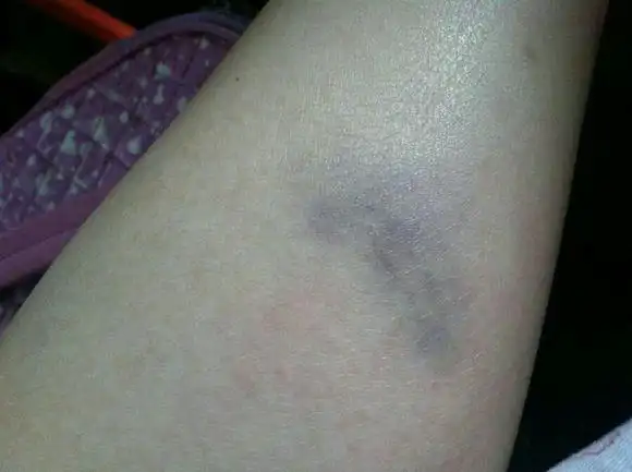 卧室中碰伤后淤青怎么处理