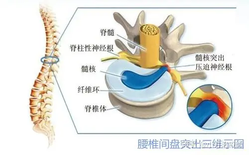 腰椎间盘突出微创手术与康复指南