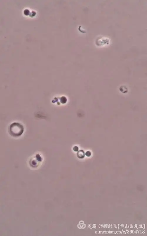 非新鲜尿中的棘形红细胞