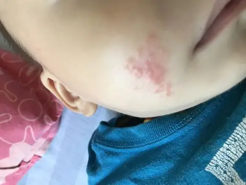 11个月宝宝 脸上长这个东西是什么 摸药后见好转 过一段时间又长出来