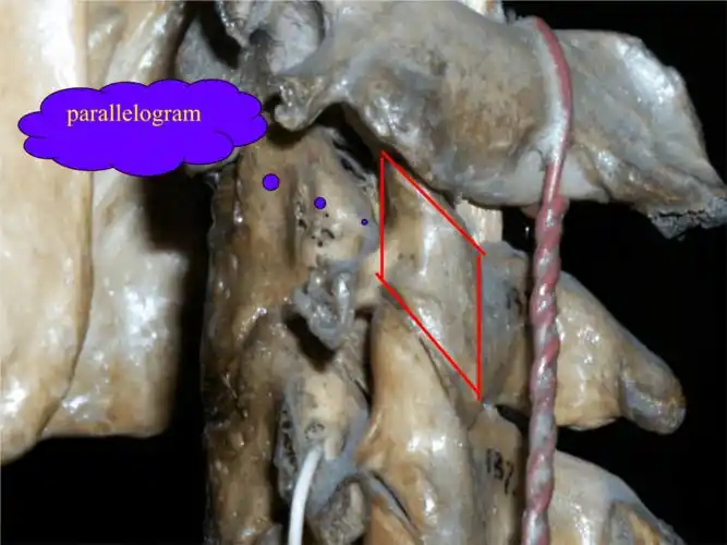 骨科ppt课件颈椎侧块钢板螺钉内固定术.ppt