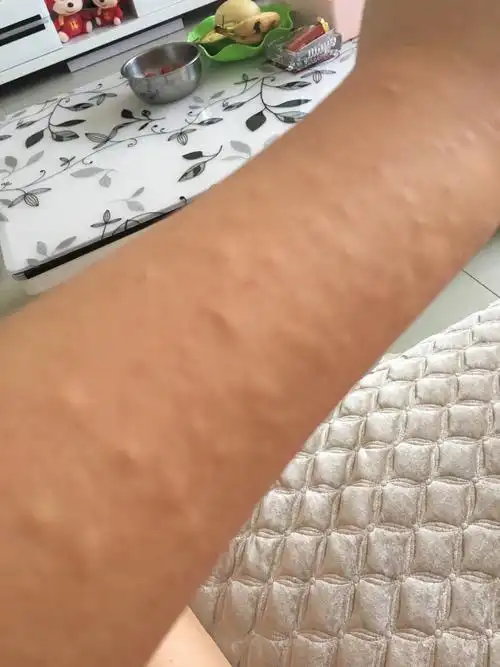 浑身长疙瘩 宝妈们帮忙看看是怎么回事 有图慎入