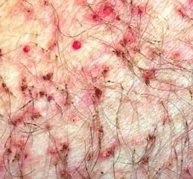 阴虱病症状与治疗