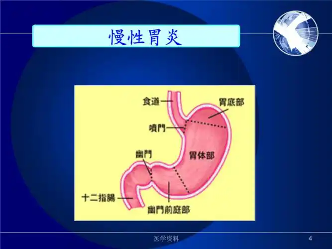 慢性胃炎护理查房ppt32页