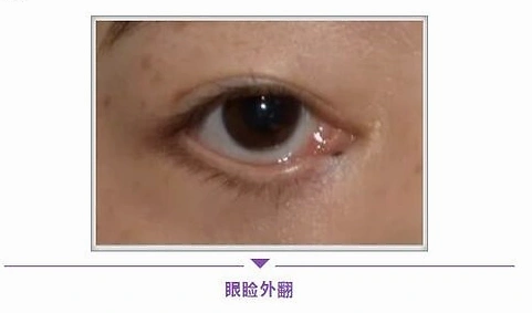 眼袋原本的差异上,制定严谨的切取量很重要,过多的切除皮肤是眼睑外翻