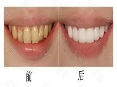 做16颗全瓷牙齿贴面前后对比