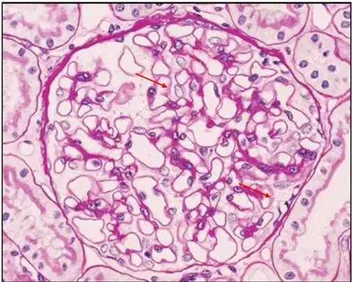肾内病理图解:膜性肾病