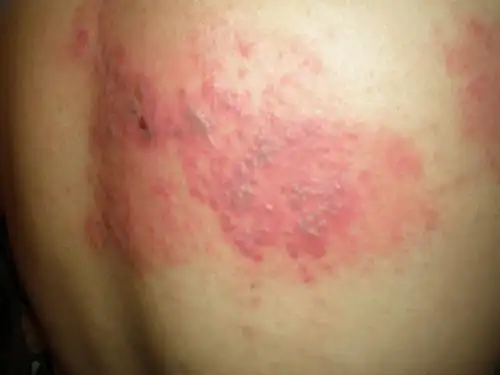 蜘蛛疮能扎破吗_其他皮肤病_北京京城皮肤病医院(北京医保定点机构)