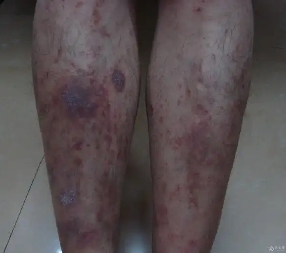 请教双脚对称性红斑请问这是什么皮肤病