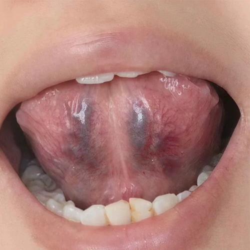 舌下青筋又黑又粗淤血舌头冷黑紫粗大疏通舌头底部血管怒张喷剂