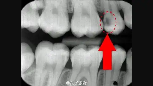 看看看看,暗影部位,蛀牙已经很深了.