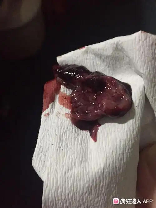 今天药流,排出来了这么一块东西.不知道是不是孕囊!算是排出来了吗?