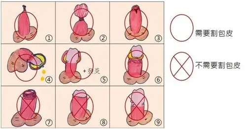 包皮过长一定要割包皮吗?除了手术之外,原来还可以这样做!