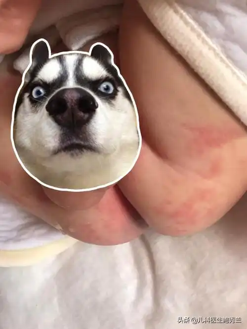 头条问答 - 宝宝屁股肛门周围总是红红的,该怎么护理啊?(3个回答)