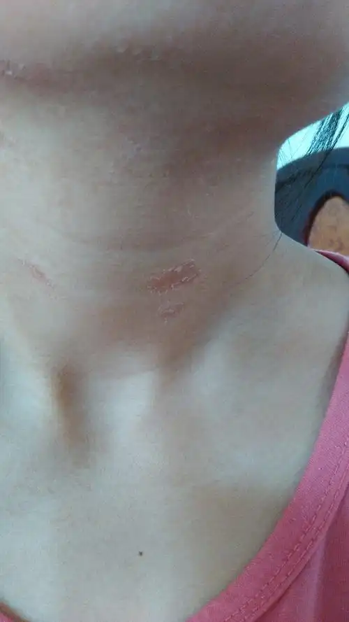 但是蔓延很快,有点痒,一碰就疼,红斑上起皮屑,请问这是什么皮肤病?