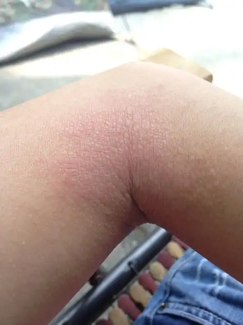 这是什么癣啊,急求助,谢谢