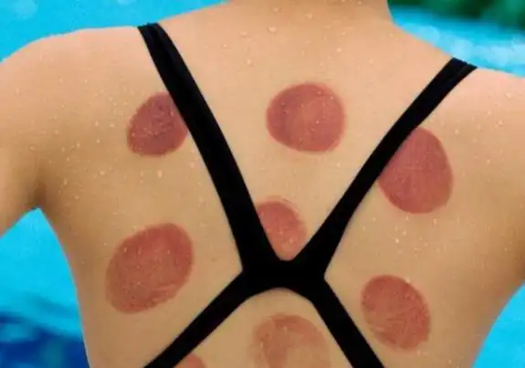 效果也就越好,这种想法非常的错误,拔火罐时间过长,伤害到皮肤会出现