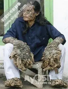 10种确实存在的变异人类[重口味],慎入