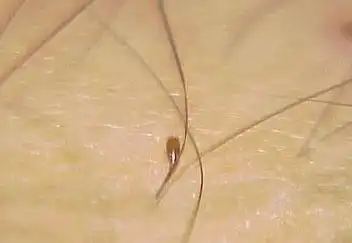 阴虱病症状与治疗