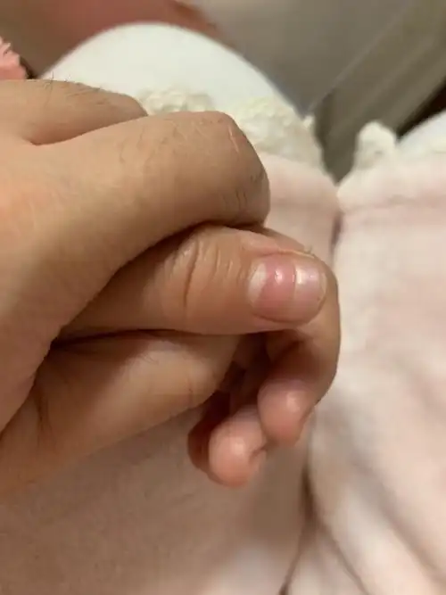 五岁小孩指甲一层层脱落是什么问题啊?